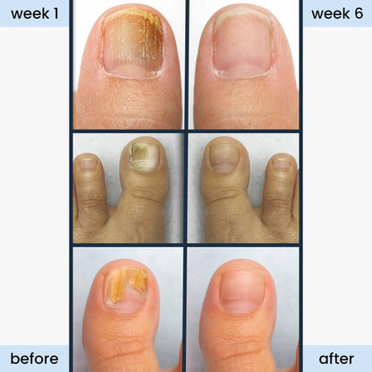 nightime antifungal nail patches