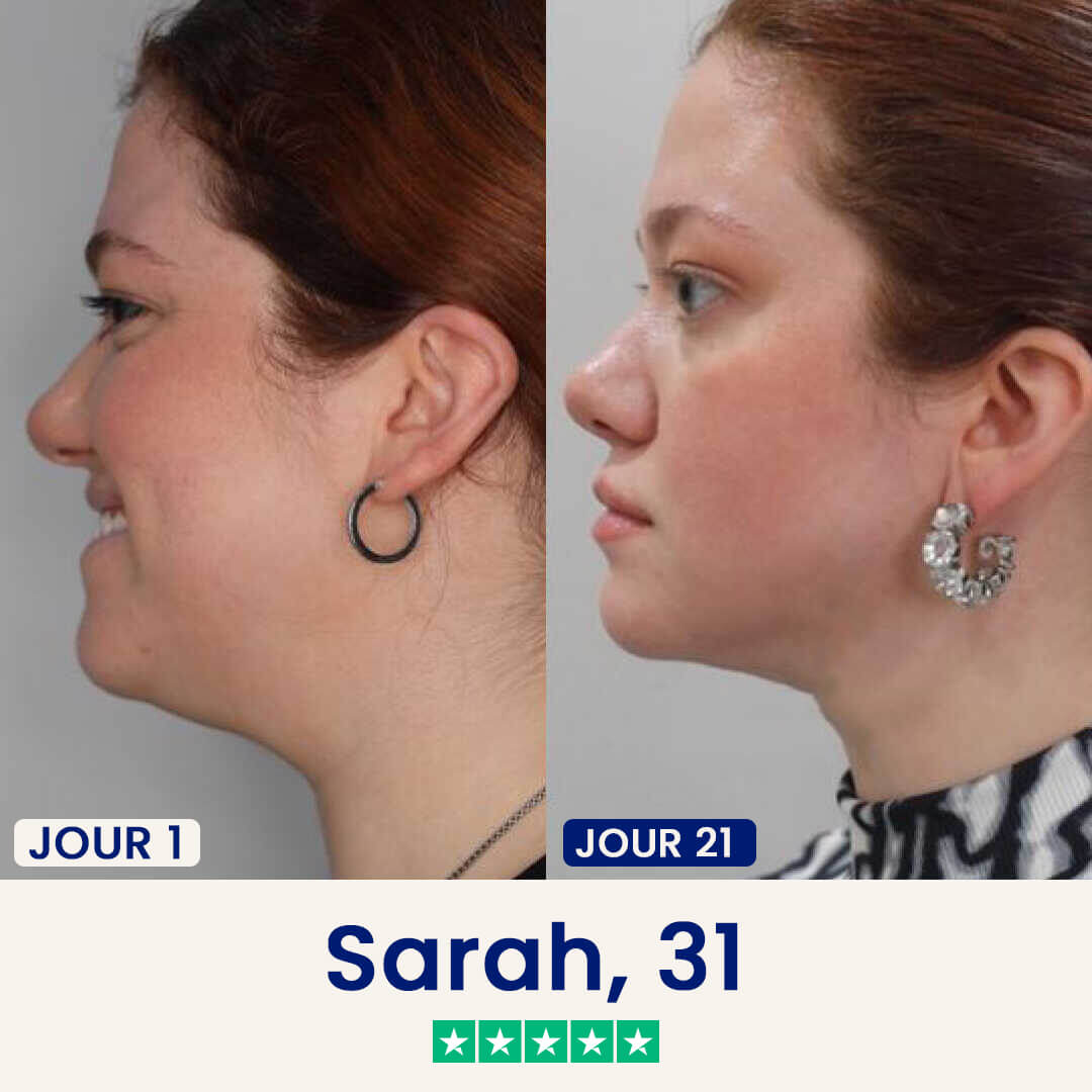 Le Chinology™ Lift (v2)